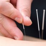 dry needling completed by an osteopath