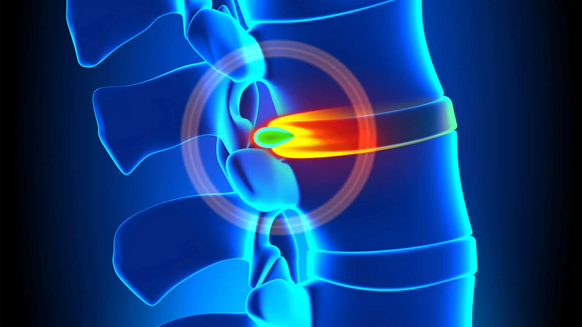 Read more about the article What is a bulging Disc?