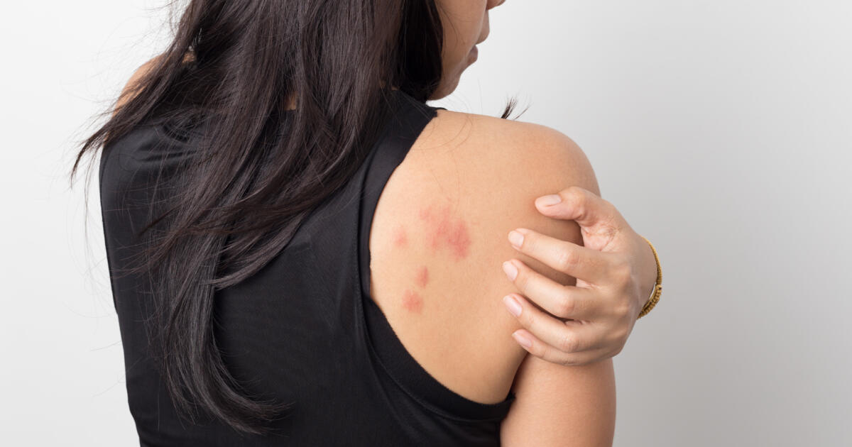 Read more about the article Shingles