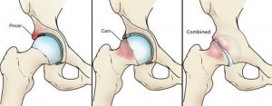 Read more about the article Femoroacetabular Impingement