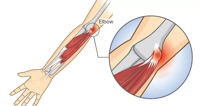 Golfer's Elbow - Medial Elbow Pain - Medial Epicondylitis