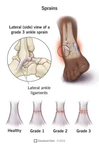 types of sprains