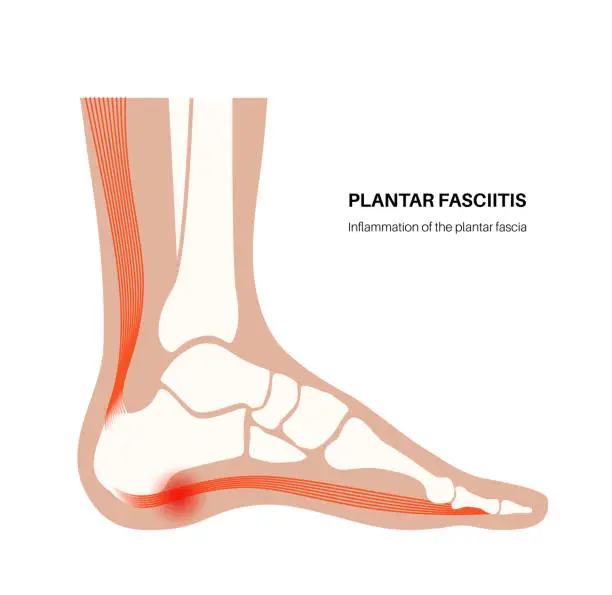 Plantar Fasciitis