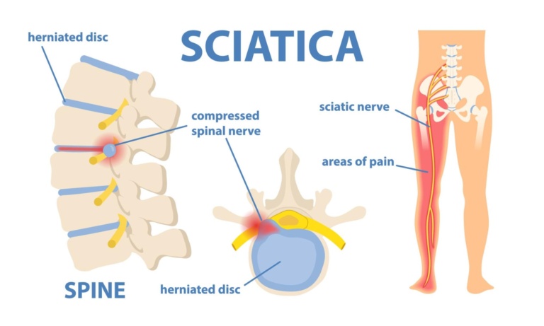 Sciatica: Causes, Symptoms, and Effective Treatment