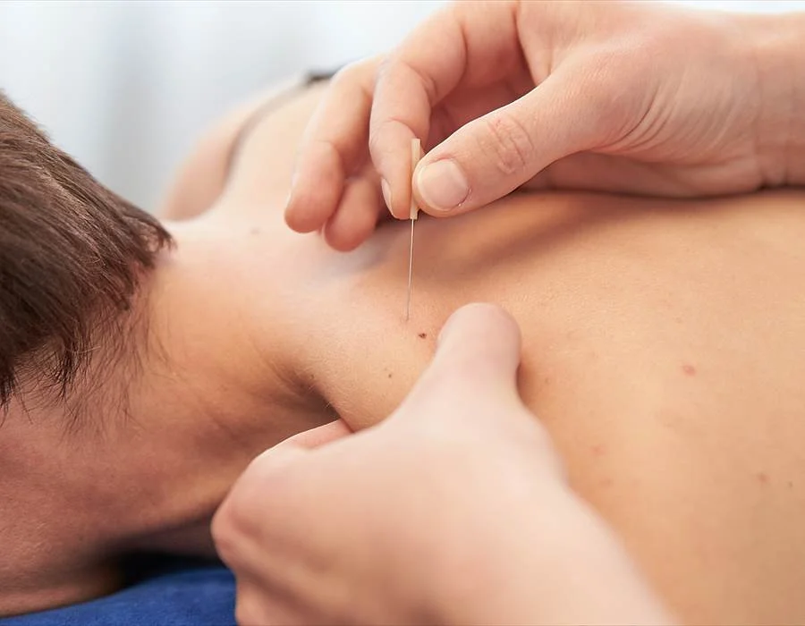 Read more about the article Dry Needling for Pain: Latest Evidence & Safety